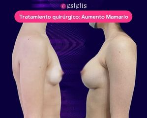 Aumento Mamario - Estetis