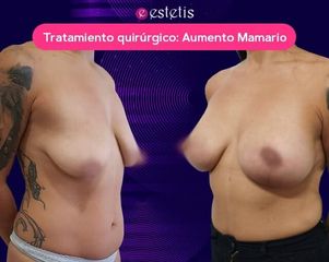 Aumento Mamario  - Estetis