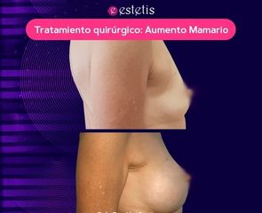 Aumento Mamario - Estetis
