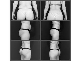 Dr. Honorio Labaronnie - Lipoescultura