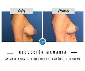 Reducción de mamas - Dr. Honorio Labaronnie