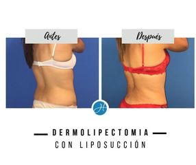 Dermolipectomía - Dr. Honorio Labaronnie
