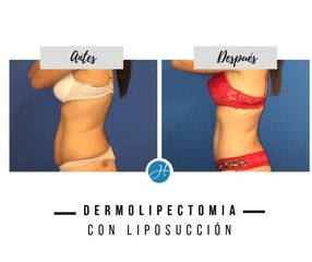 Liposucción - Dr. Honorio Labaronnie