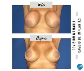Mastopexia - Dr. Honorio Labaronnie