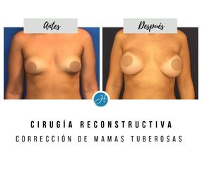 Mastopexia - Dr. Honorio Labaronnie