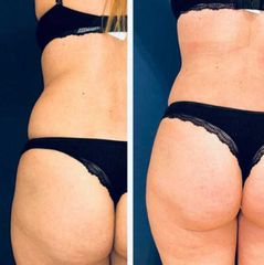 Liposucción - Dr. Honorio Labaronnie