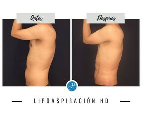 Liposucción - Dr. Honorio Labaronnie