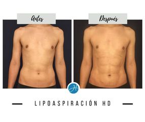 Liposucción - Dr. Honorio Labaronnie