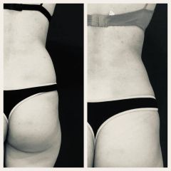 Liposucción - Dr. Honorio Labaronnie