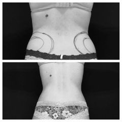 Liposucción - Dr. Honorio Labaronnie