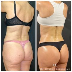 Liposucción - Dr. Honorio Labaronnie