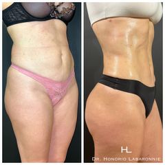 Liposucción - Dr. Honorio Labaronnie