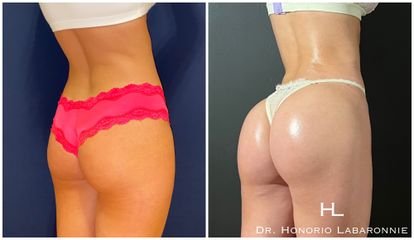 Liposucción - Dr. Honorio Labaronnie
