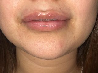 Relleno labios, Dr. Honorio Labaronnie