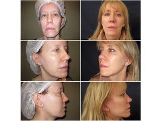 Lifting facial