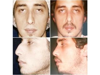 Rinoplastia