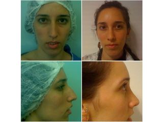 Rinoplastia