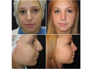Rinoplastia