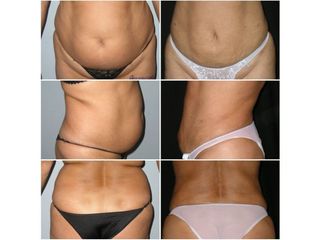 Lipoescultura