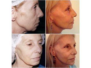 Lifting facial con implante de mentón