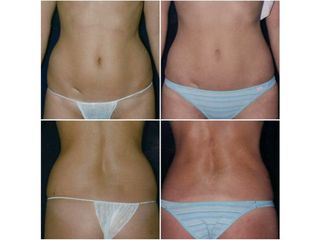 Lipoescultura