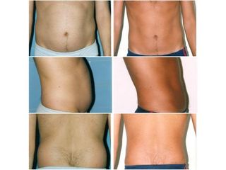Lipoescultura