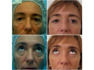 Blefaroplastia - Bioestética Group