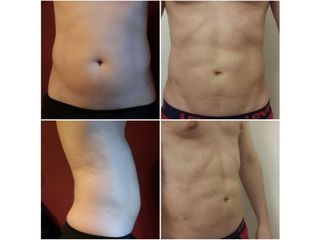 Marcación Abdominal