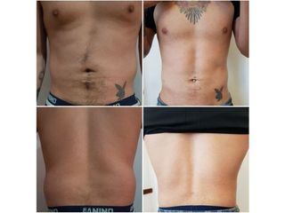 Lipoescultura