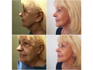 Lifting facial con cuello