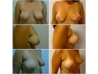 Mastopexia