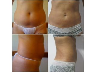 Lipoescultura