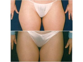 Lipoescultura