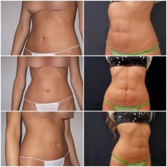 Marcación abdominal