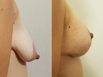 Mastopexia antes y después - 880055