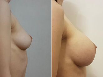 Aumento mamas antes y después - 880056