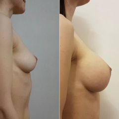 Aumento mamario - Bioestética Group