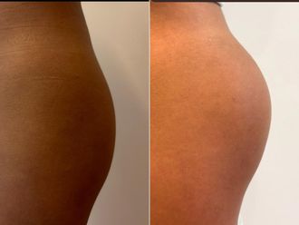 Aumento glúteos antes y después - 880059