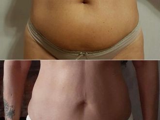 Lipoescultura antes y después - 880062