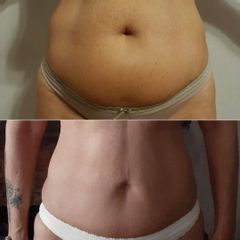 Lipoescultura - Bioestética Group