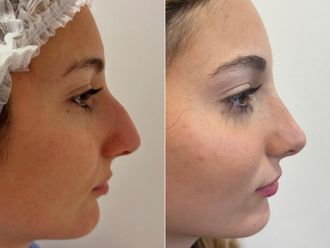 Rinoplastia antes y después - 880063