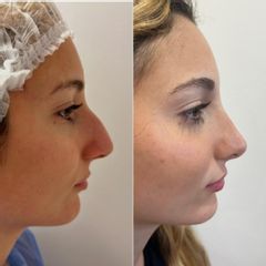 Rinoplastia - Bioestética Group