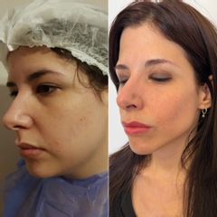 Bichectomía - Bioestética Group