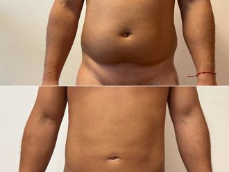 Lipoescultura antes y después - 880065