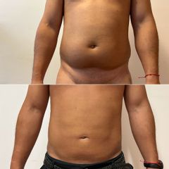 Lipoescultura - Bioestética Group