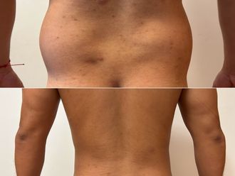 Lipoescultura antes y después - 880066