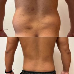 Lipoescultura - Bioestética Group