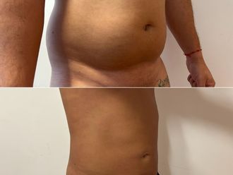 Lipoescultura antes y después - 880067