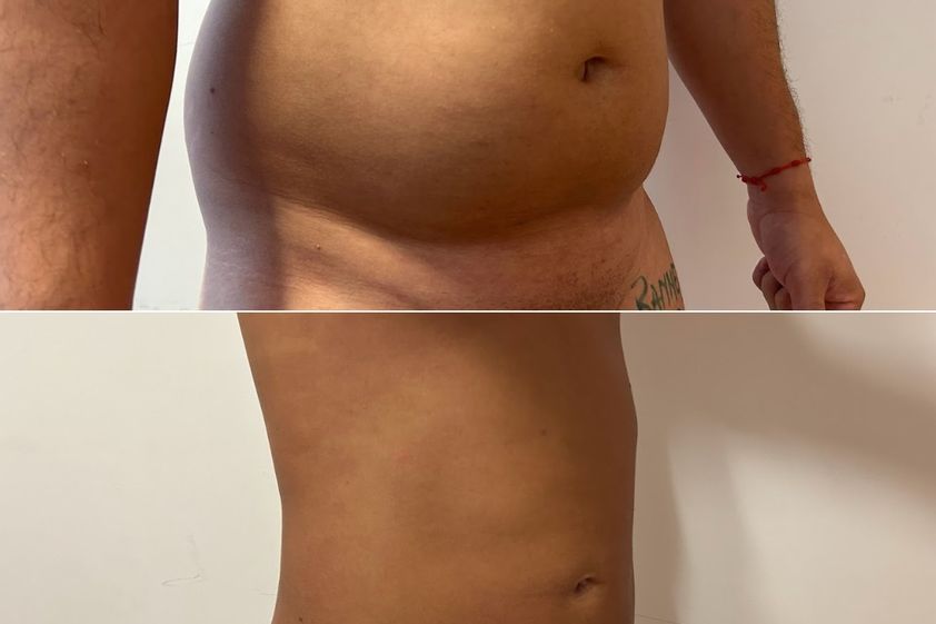 Lipoescultura antes y después - 880067
