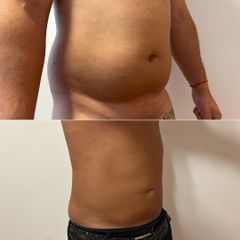 Lipoescultura - Bioestética Group